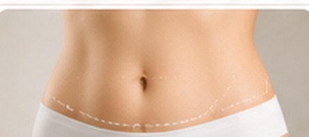 Abdominoplastie