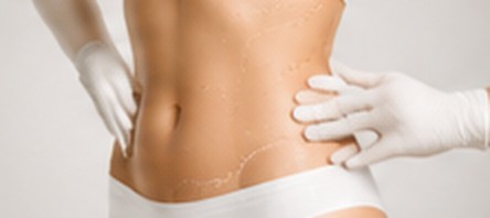 Liposuccion 360°